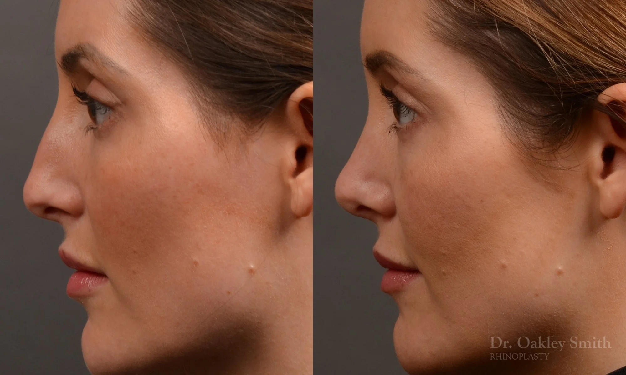 490E-rhinoplasty-dr-oakley-smith-toronto-top-surgeon-nose-job.jpg