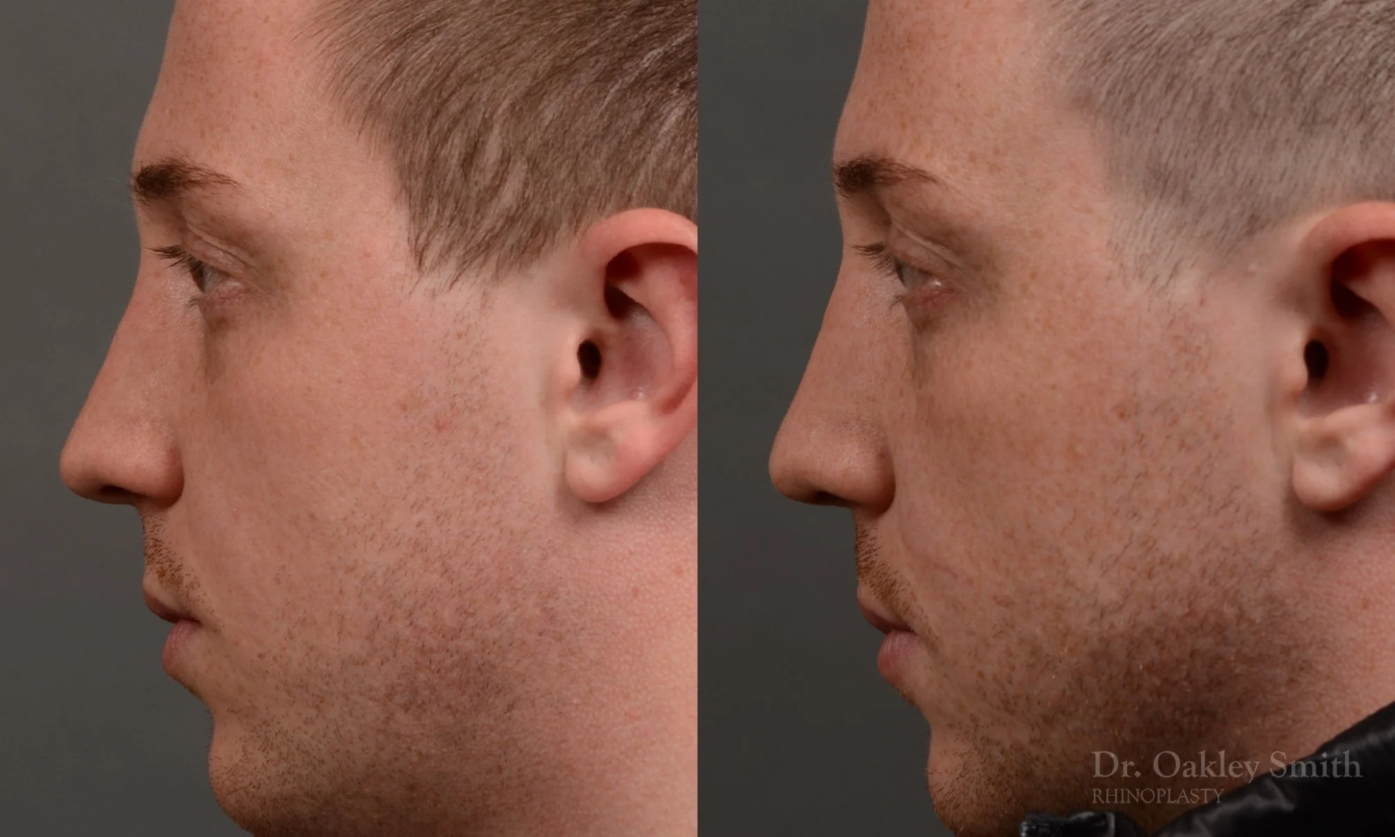 339.1E-rhinoplasty-dr-oakley-smith-toronto-male-nose-job.jpg