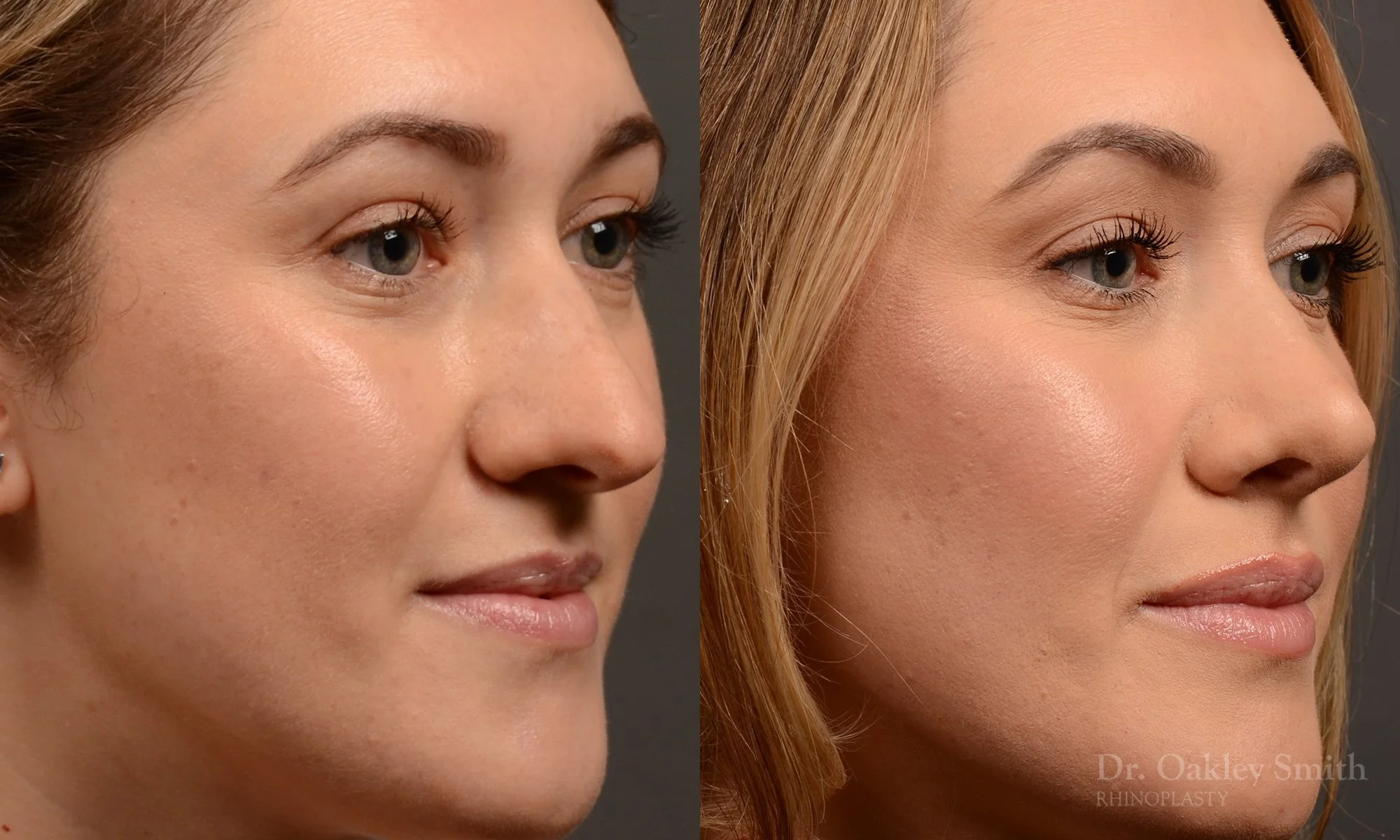 497B-rhinoplasty-dr-oakley-smith-toronto-top-surgeon-nose-job.jpg