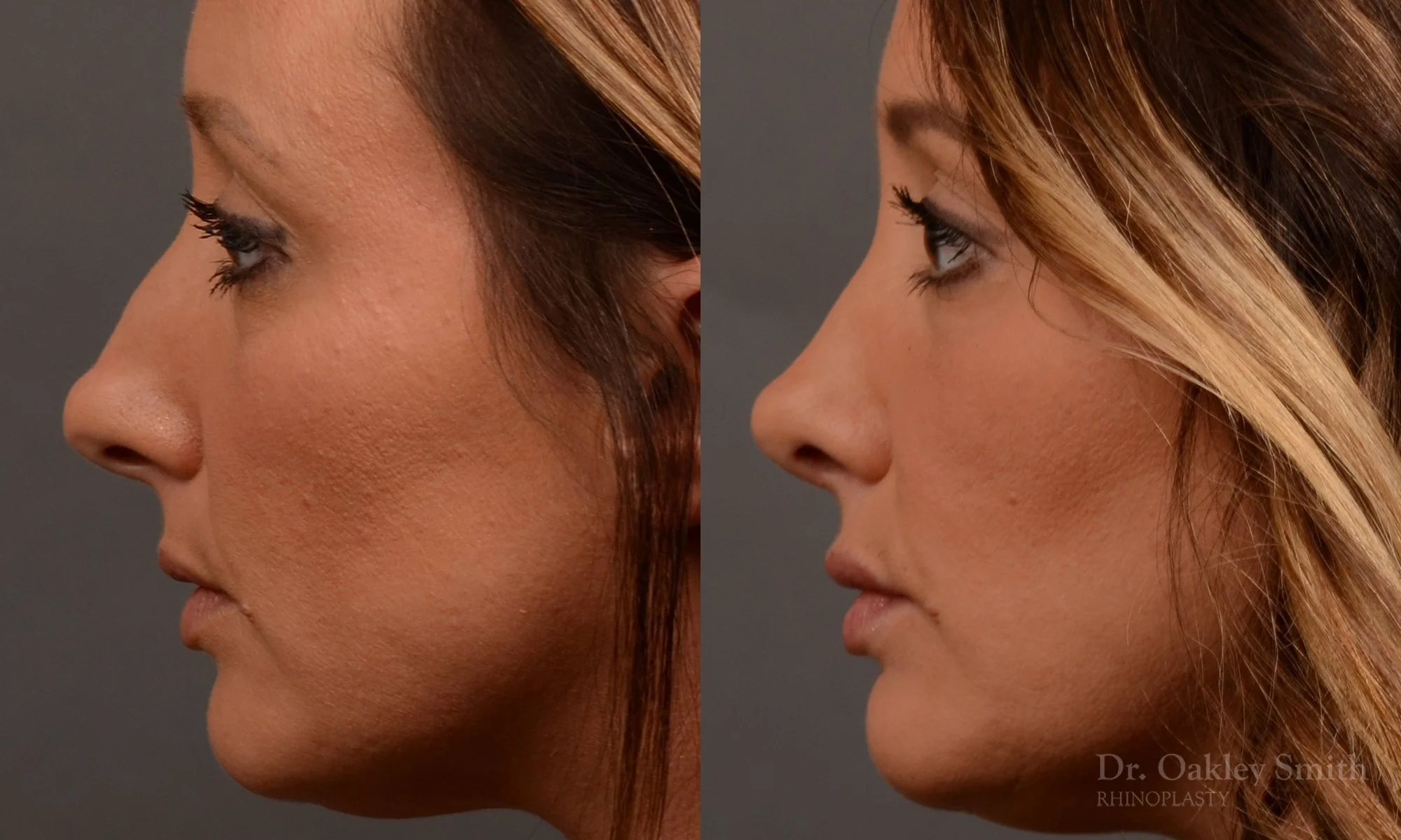 499E-rhinoplasty-dr-oakley-smith-toronto-top-surgeon-nose-job.jpg