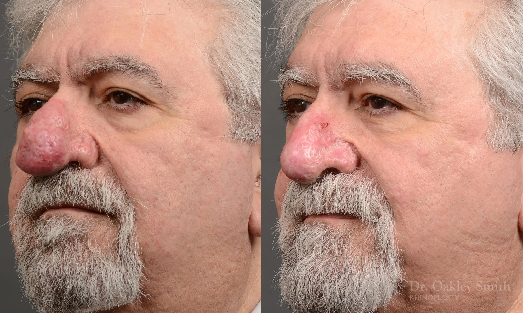 Case 562, Dr. Oakley Smith, rhinophyma rhinoplasty, 12 months after surgery, left oblique view