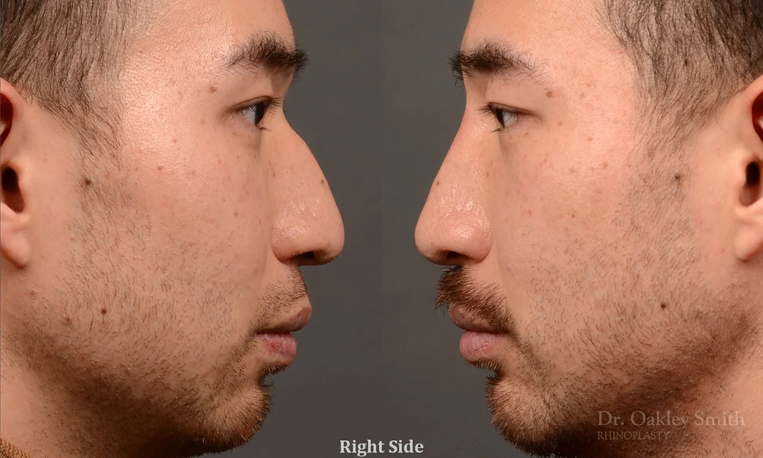 522: Male Filler Rhinoplasty, Normal Skin, Bridge Work, Tip Work