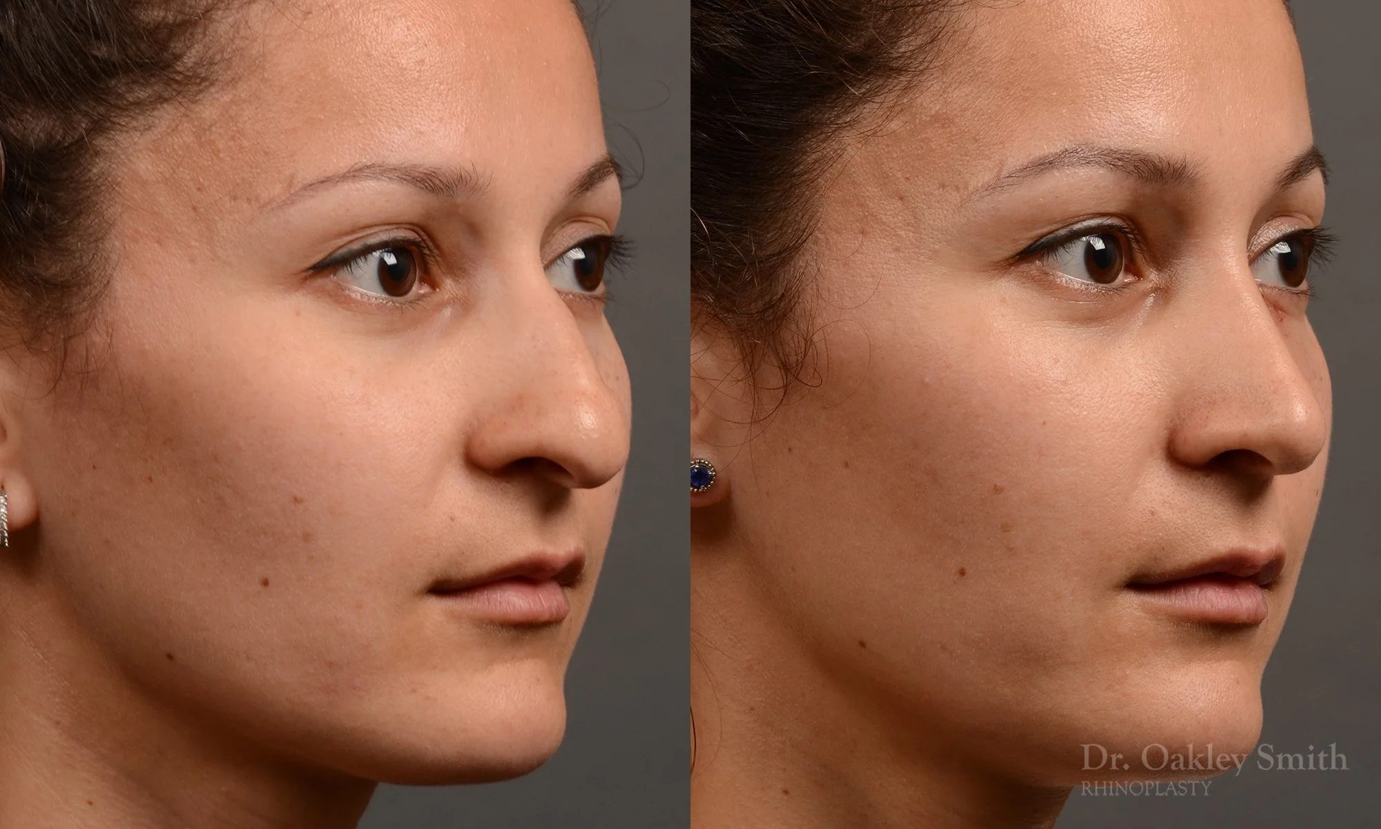 332B-rhinoplasty-dr-oakley-smith-toronto-nose-job.jpg