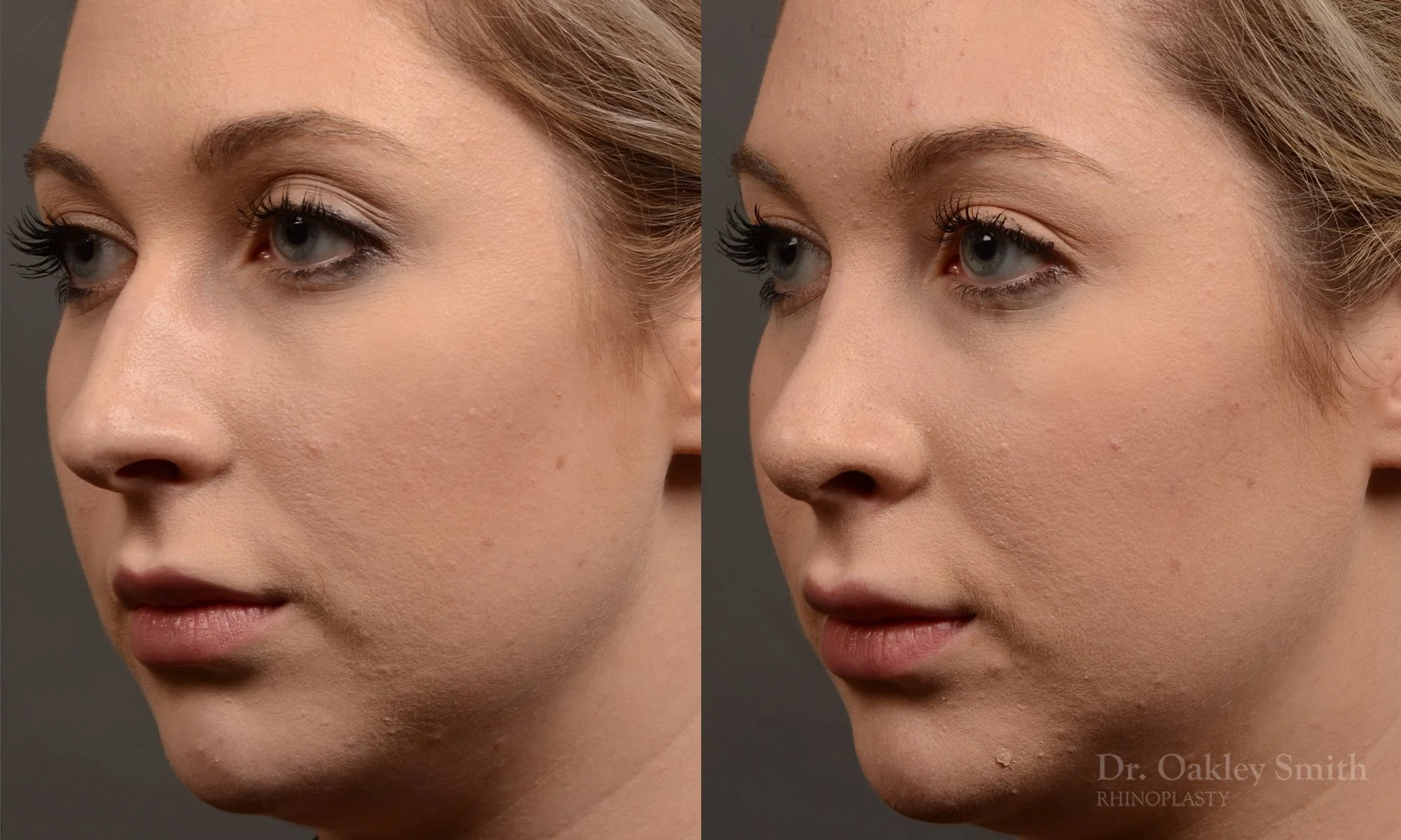 348D-rhinoplasty-dr-oakley-smith-toronto-nose-job.jpg