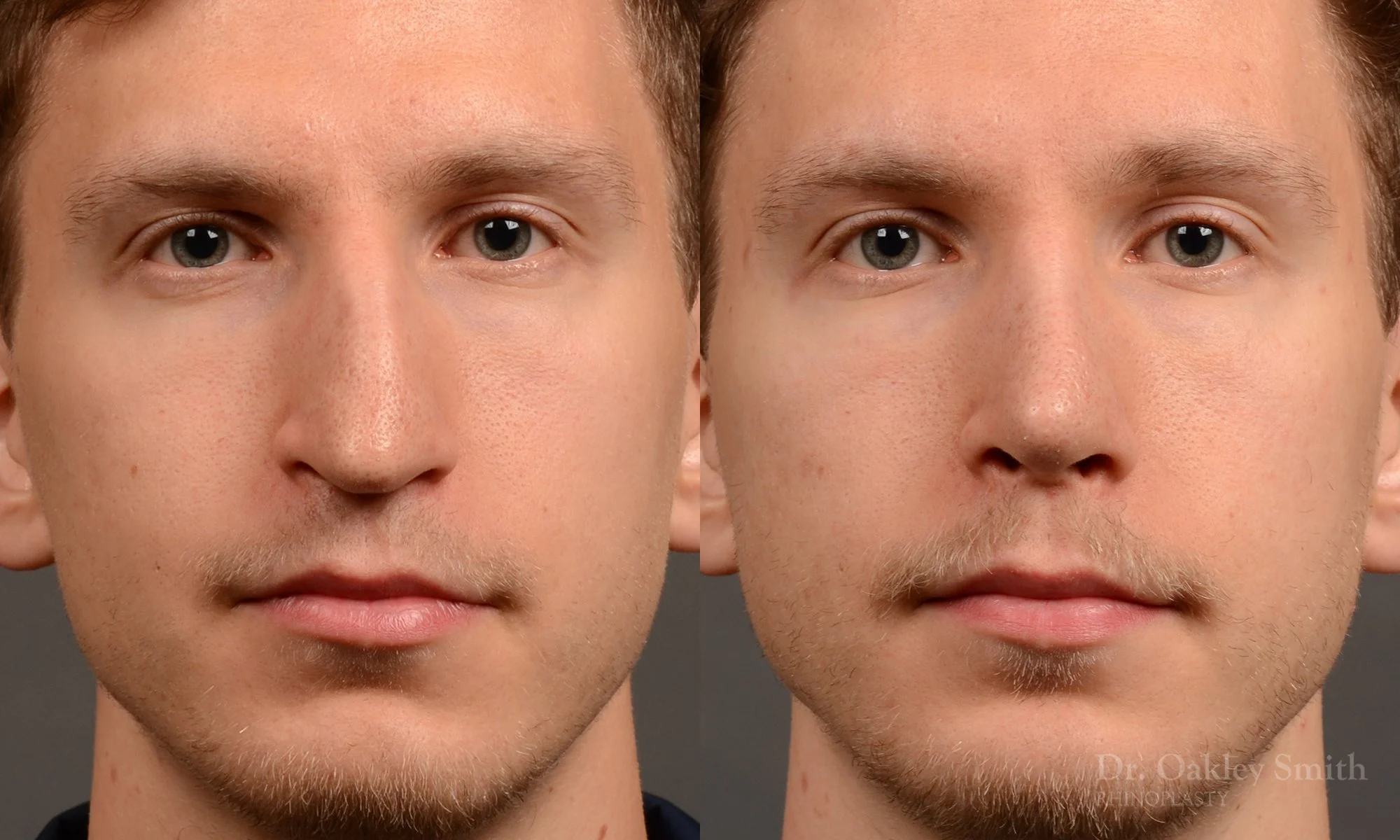 498A-rhinoplasty-dr-oakley-smith-toronto-top-surgeon-nose-job.jpg