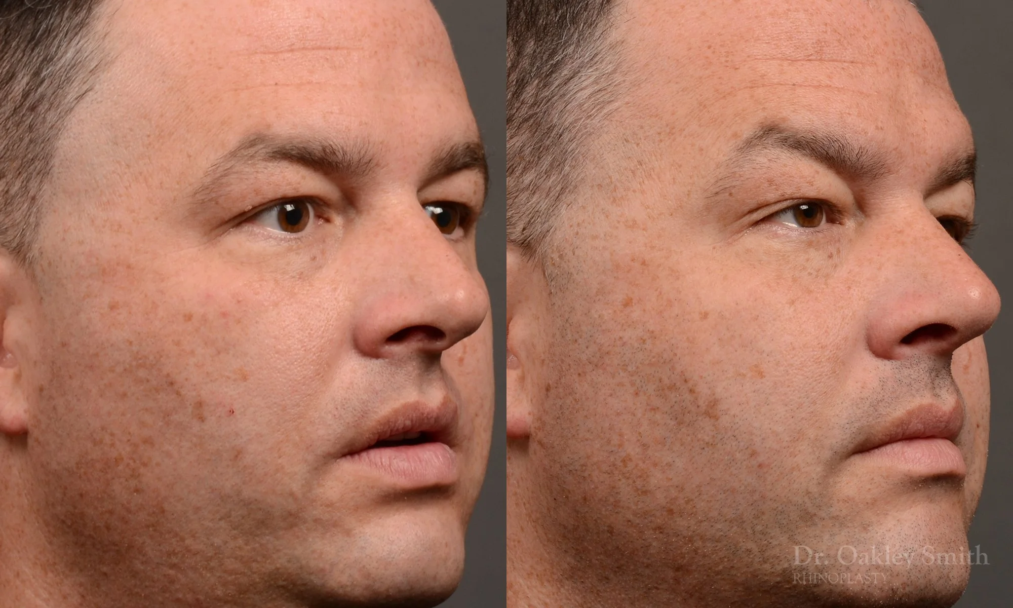 514B-male-rhinoplasty-dr-oakley-smith-toronto-nose-job.jpg