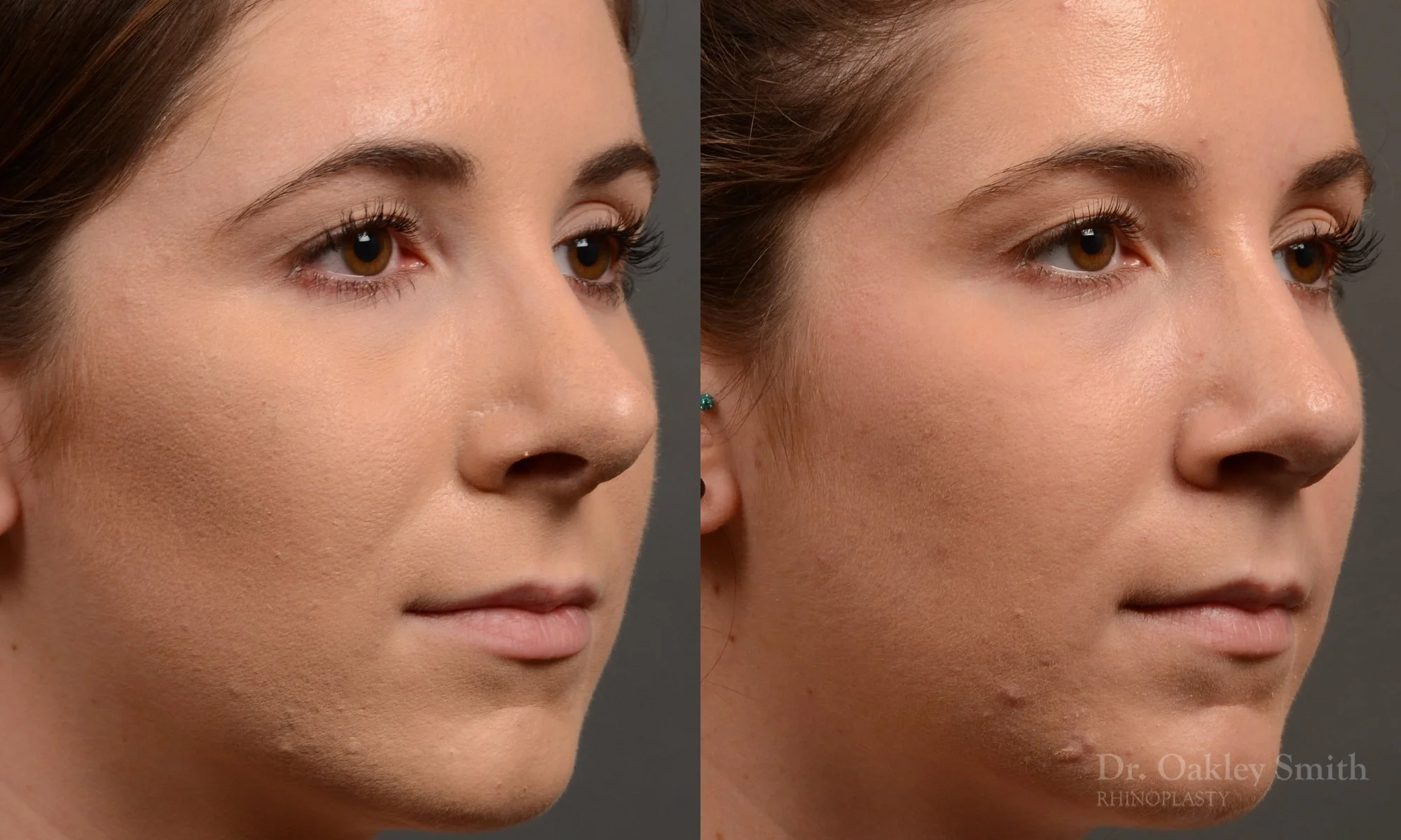 366B-rhinoplasty-dr-oakley-smith-toronto-nose-job.jpg