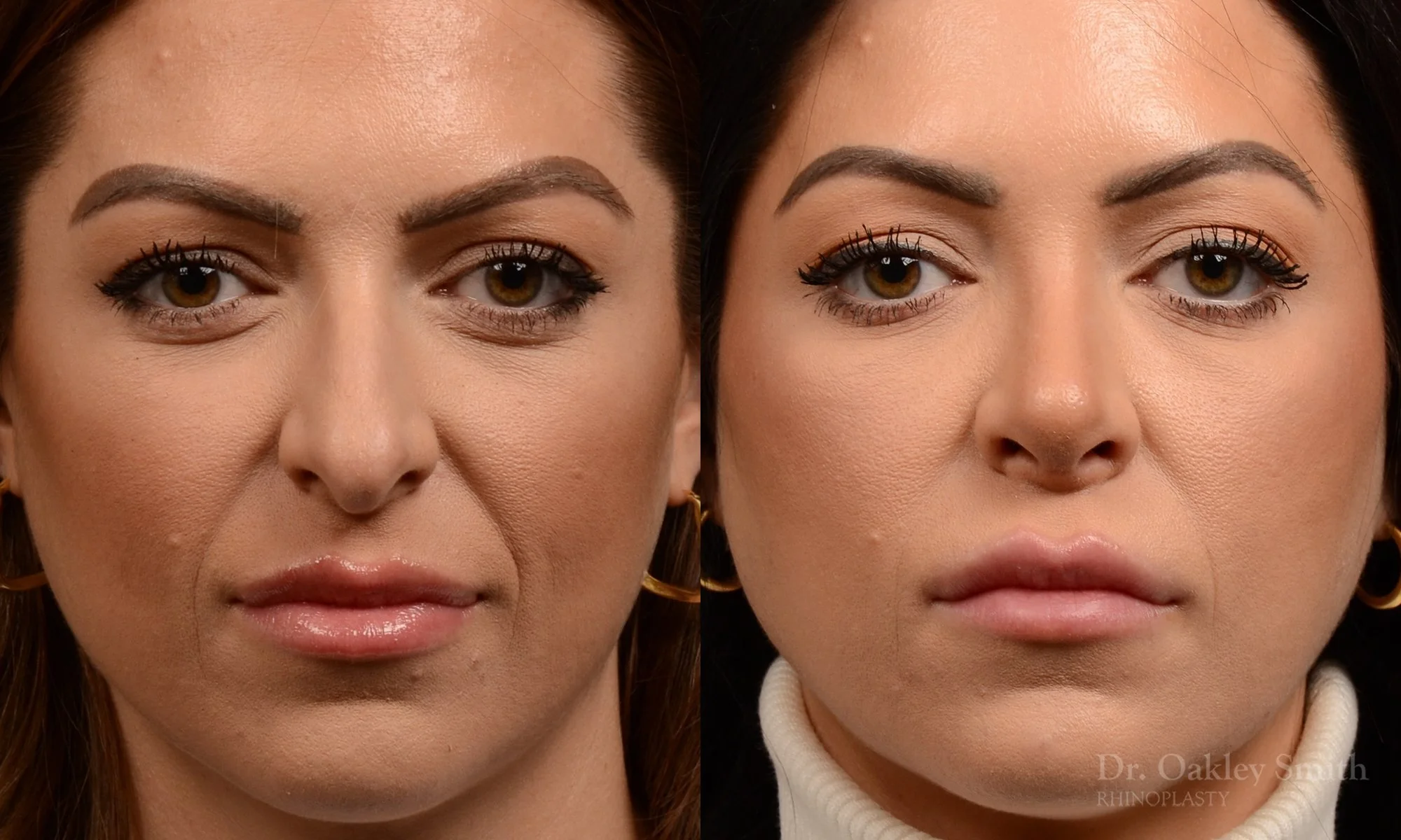 524A-rhinoplasty-dr-oakley-smith-toronto-top-surgeon-nose-job.jpg