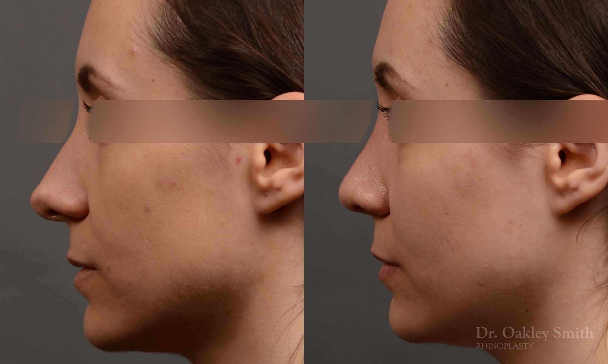 341E-rhinoplasty-dr-oakley-smith-toronto-nose-job.jpg