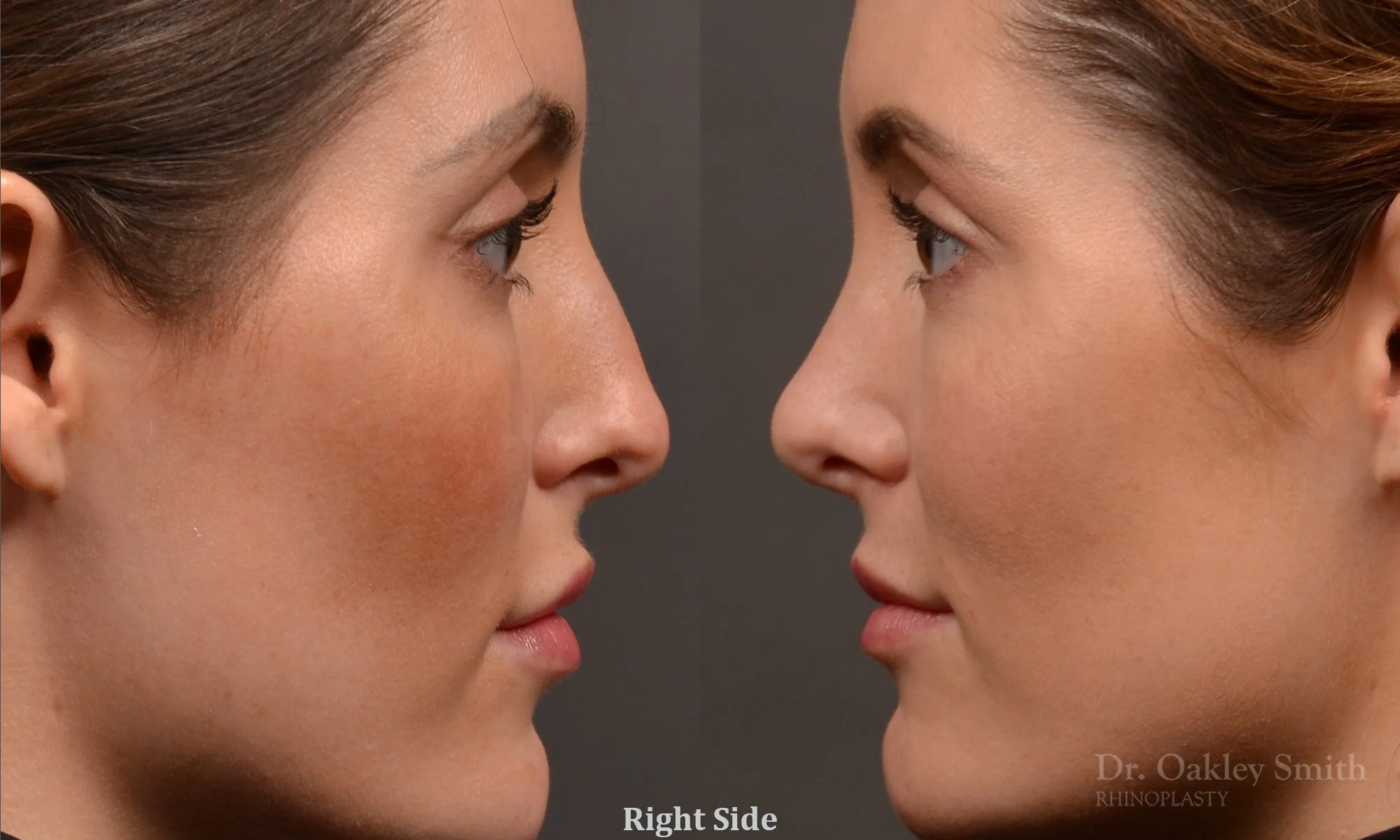 490: Female, Primary  Rhinoplasty, Normal Skin, Bridge Work, Tip Work