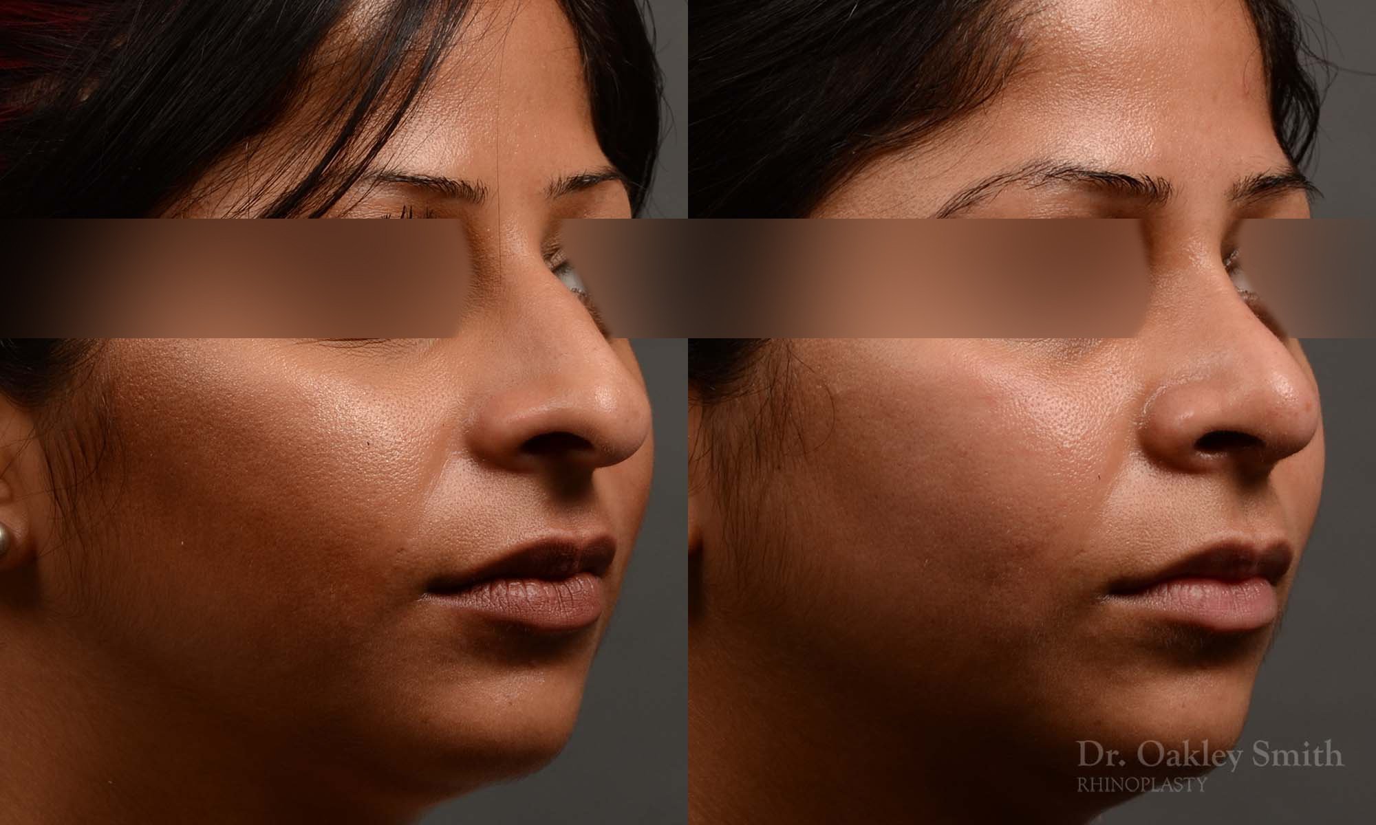 346B-rhinoplasty-dr-oakley-smith-toronto-nose-job.jpg