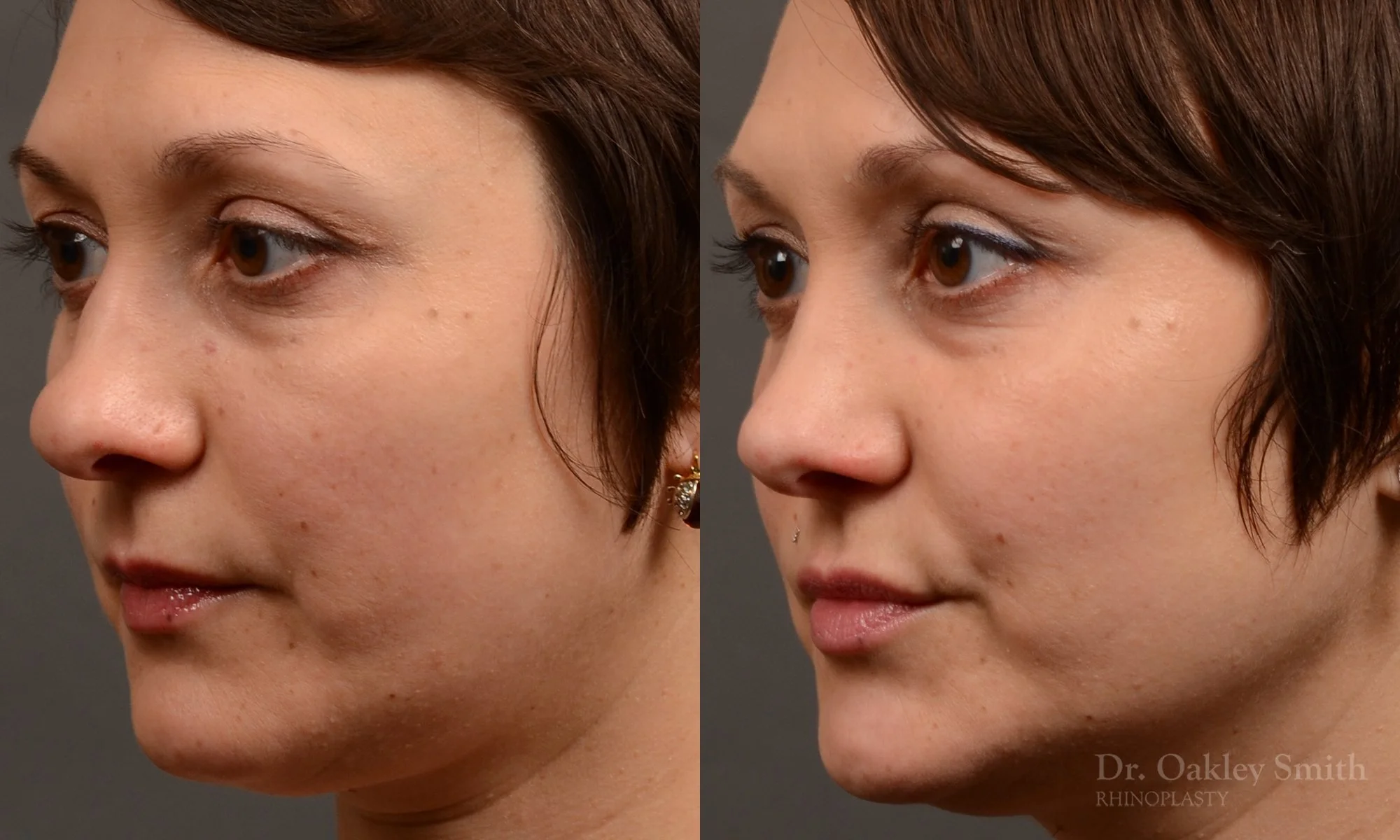 505E-rhinoplasty-dr-oakley-smith-toronto-top-surgeon-nose-job.jpg