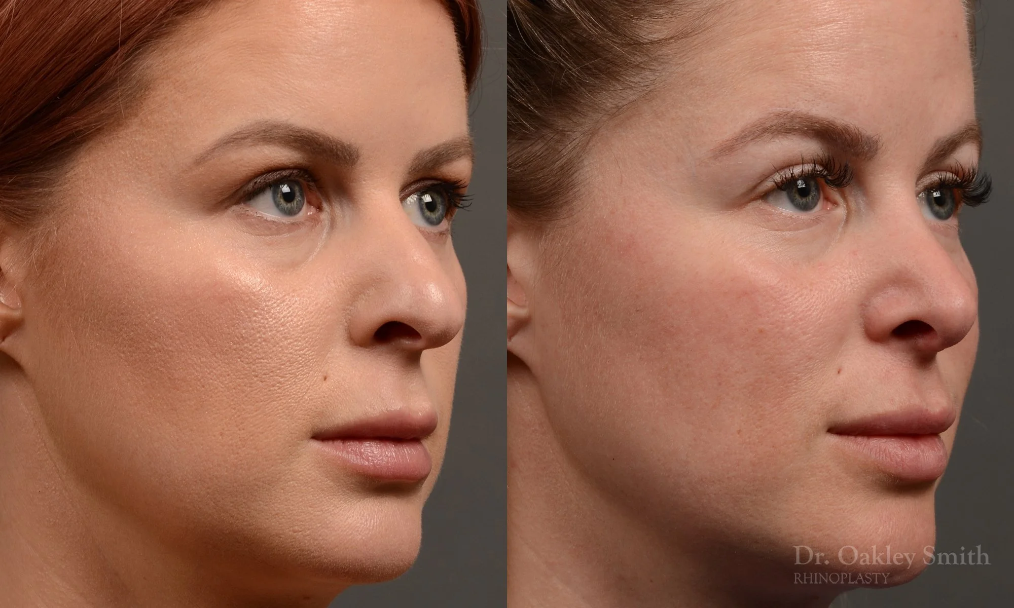 361B-rhinoplasty-dr-oakley-smith-toronto-nose-job.jpg