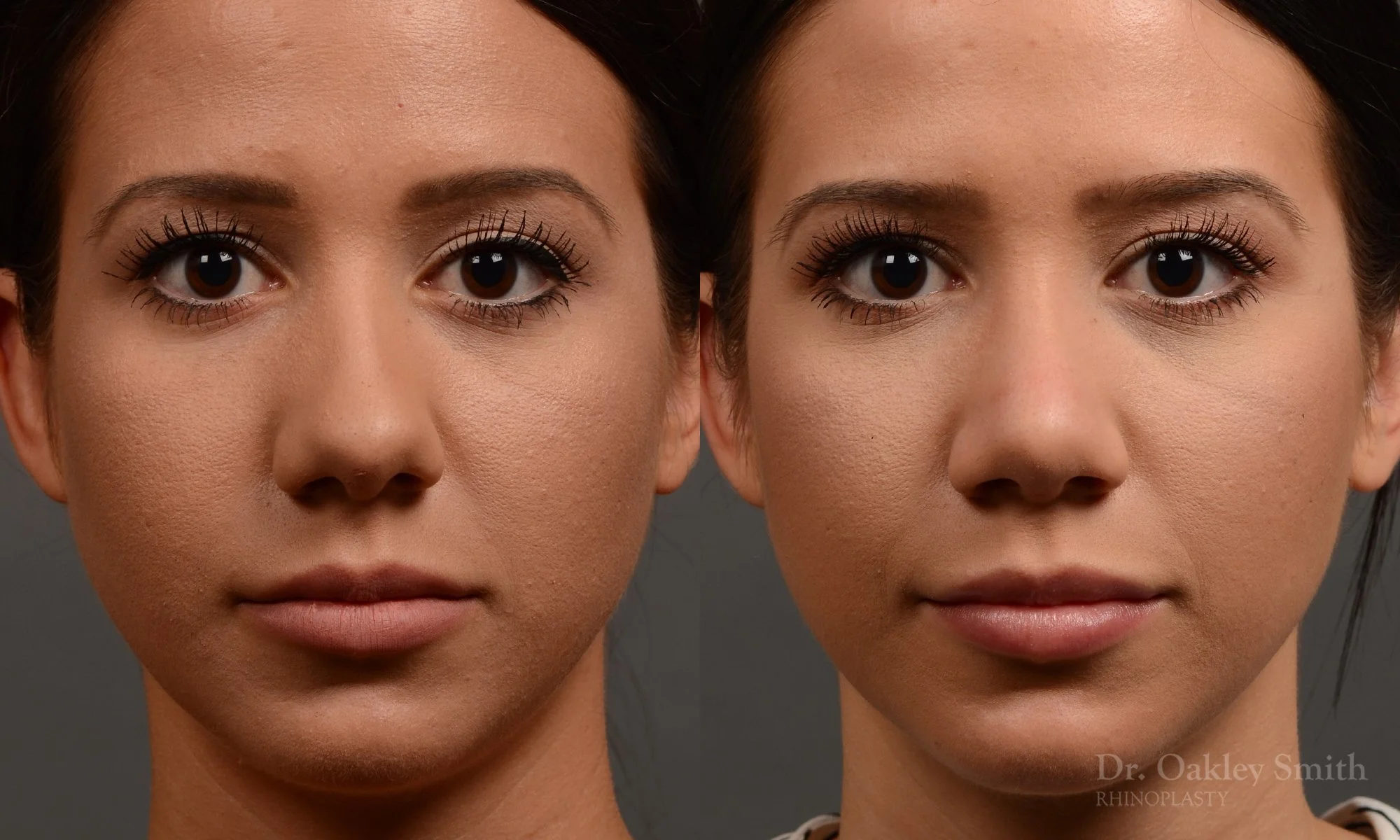 328A-rhinoplasty-dr-oakley-smith-toronto-nose-job.jpg