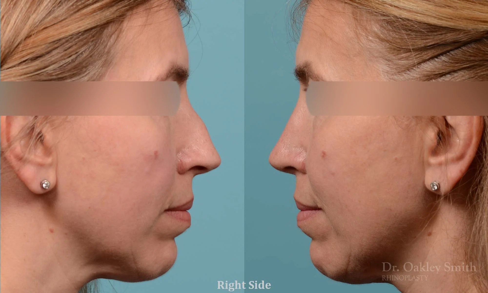 291C-rhinoplasty-dr-oakley-smith-toronto-nose-job.jpg