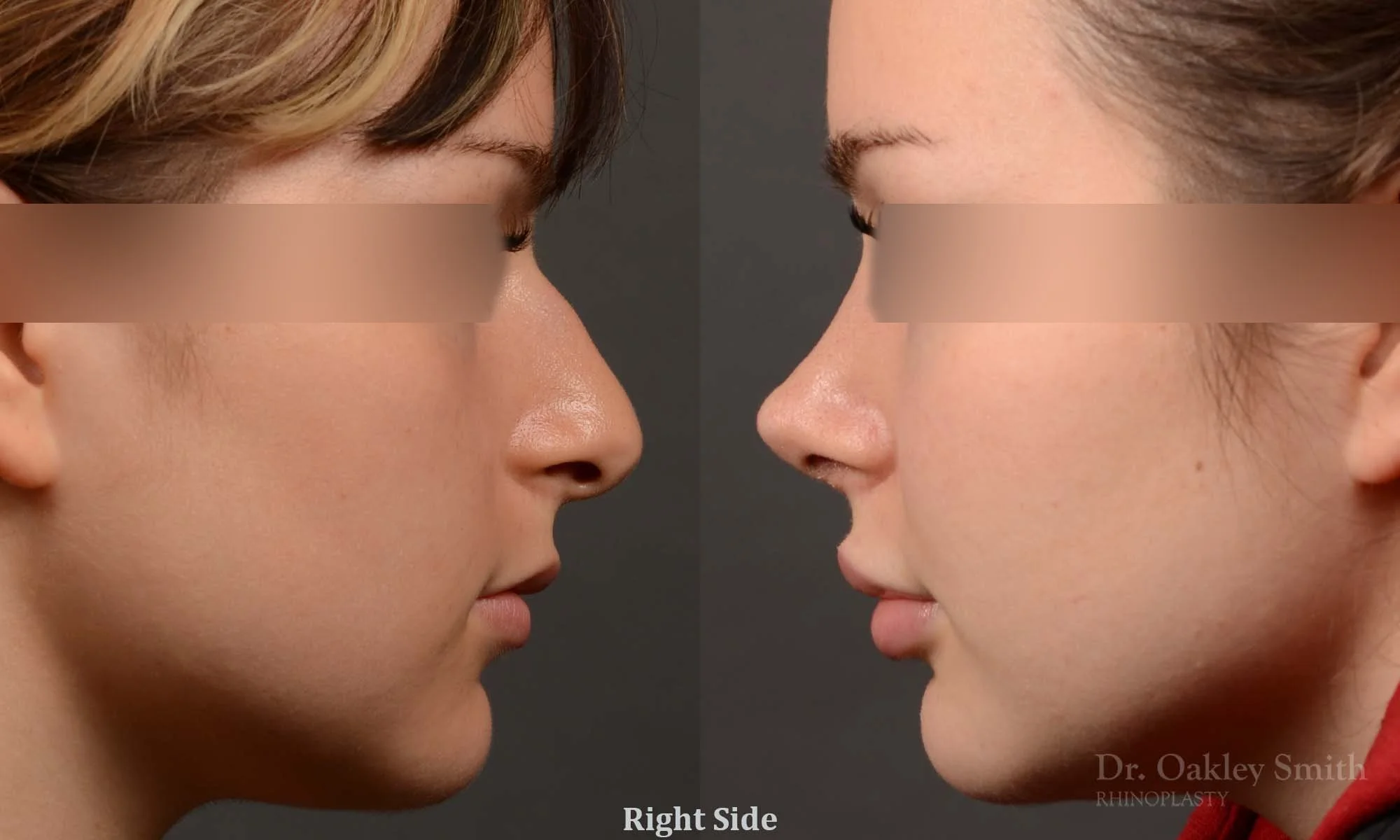 530C-rhinoplasty-dr-oakley-smith-toronto-top-surgeon-nose-job.jpg