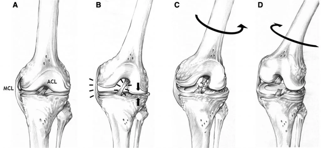 Four diagrams showing knee joint movements and insertions of ligaments, illustrating different aspects of knee motion and stability.