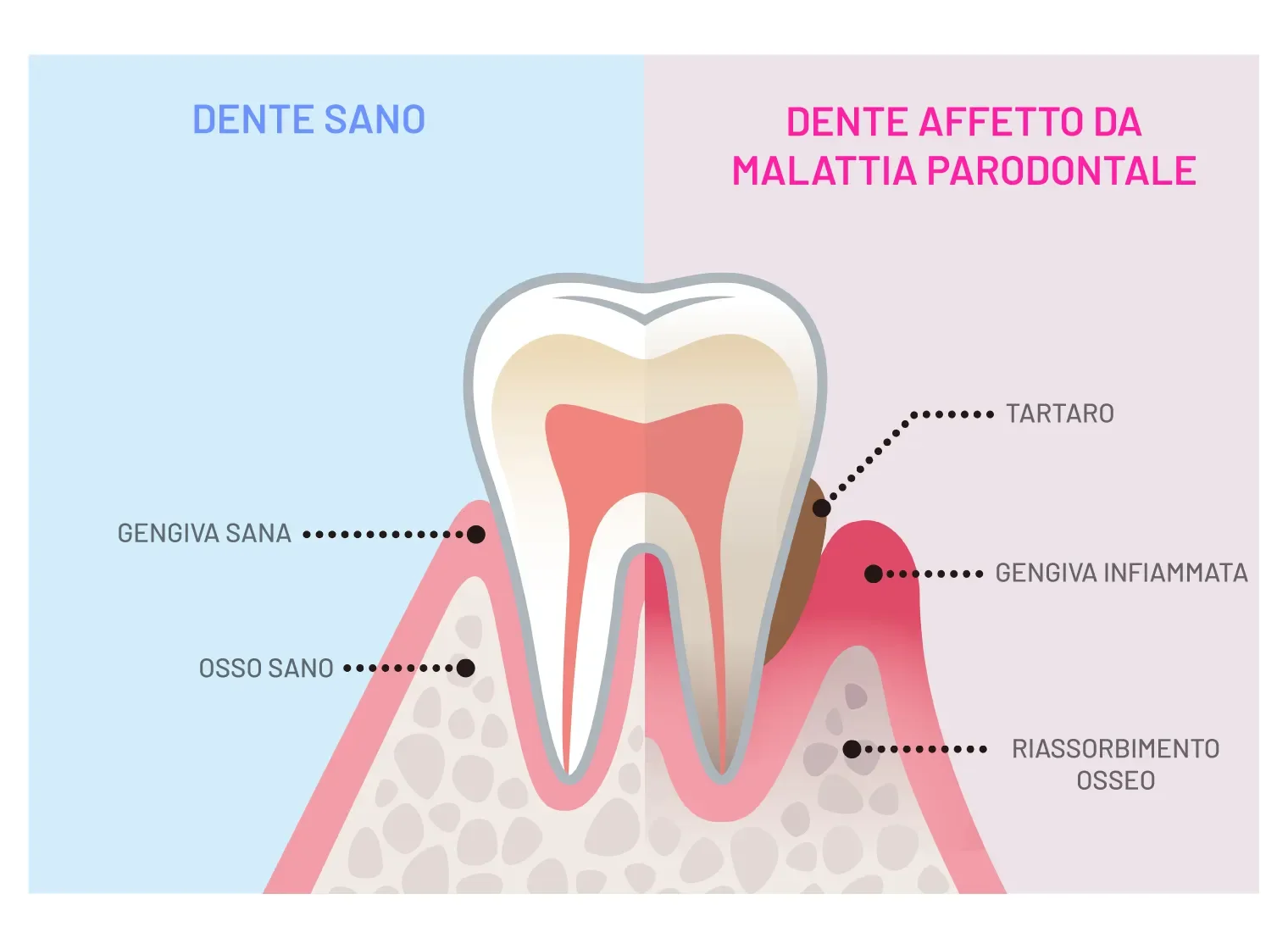 Curare la parodontite si può o meglio si deve