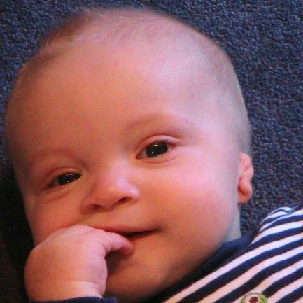 A photo of an infant with a tiny ear and no ear canal.