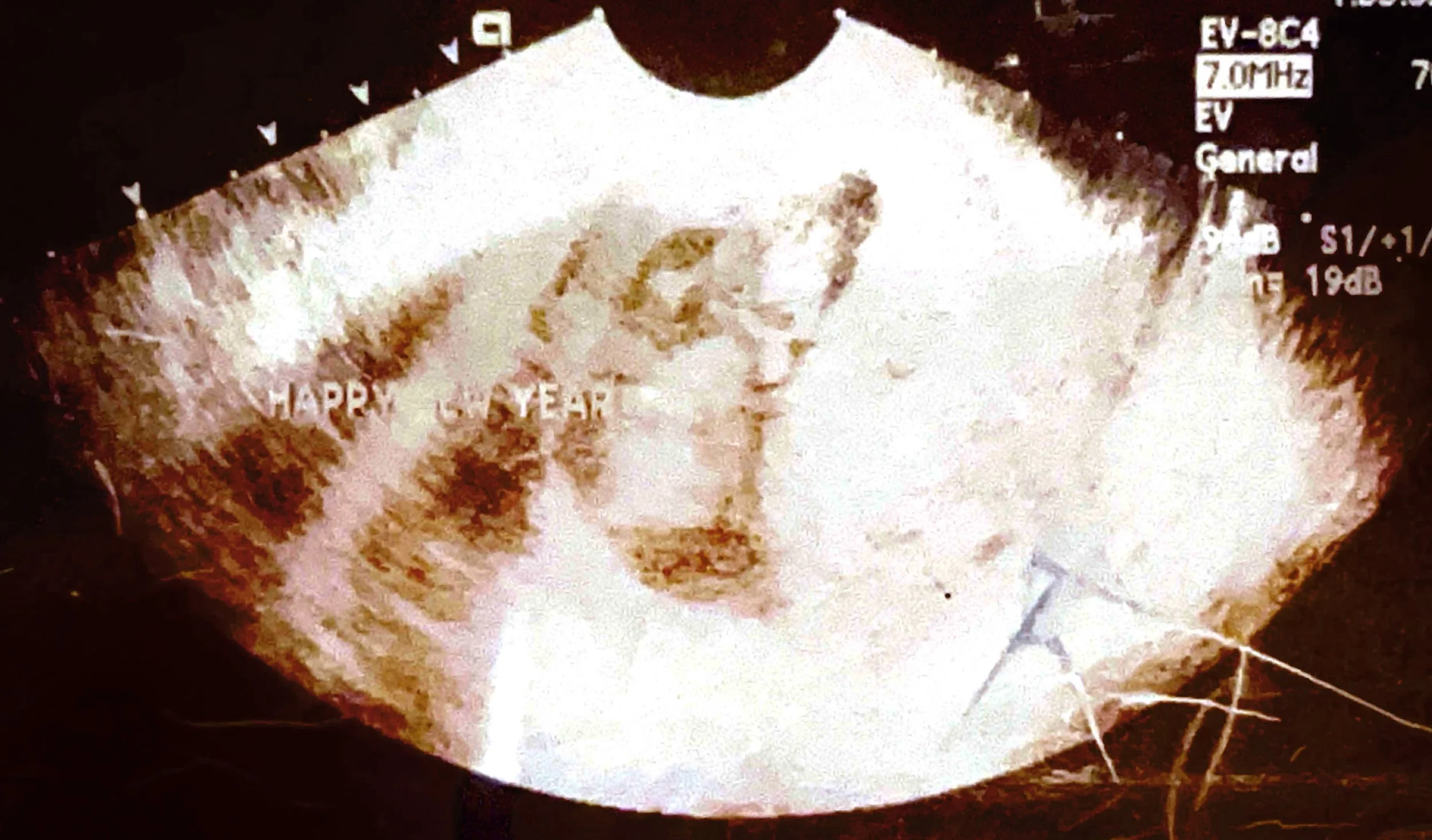 An ultrasound from early in a pregnancy.