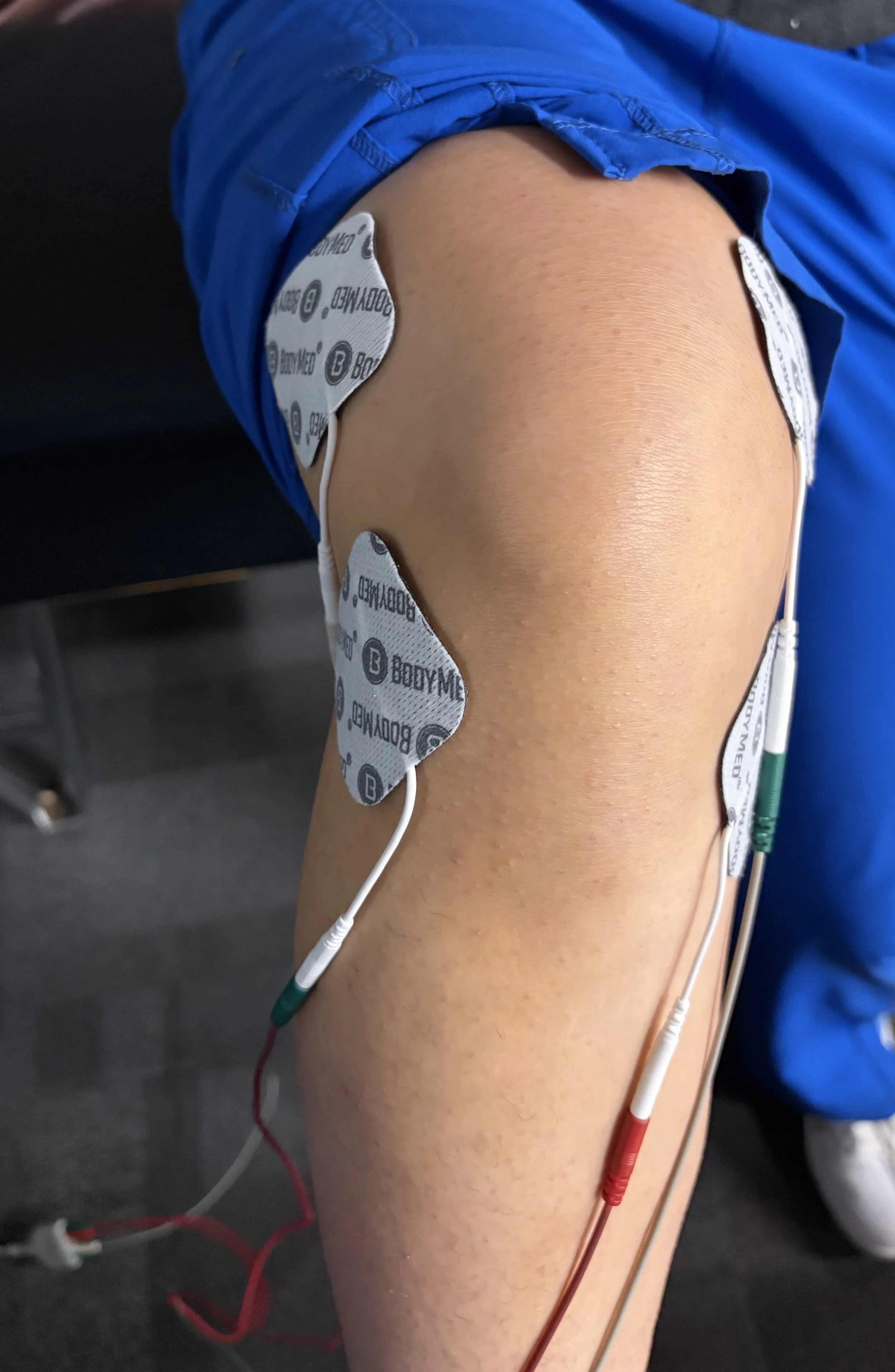 Close-up of a person's arm with electrocardiogram (ECG) electrodes attached for medical monitoring.