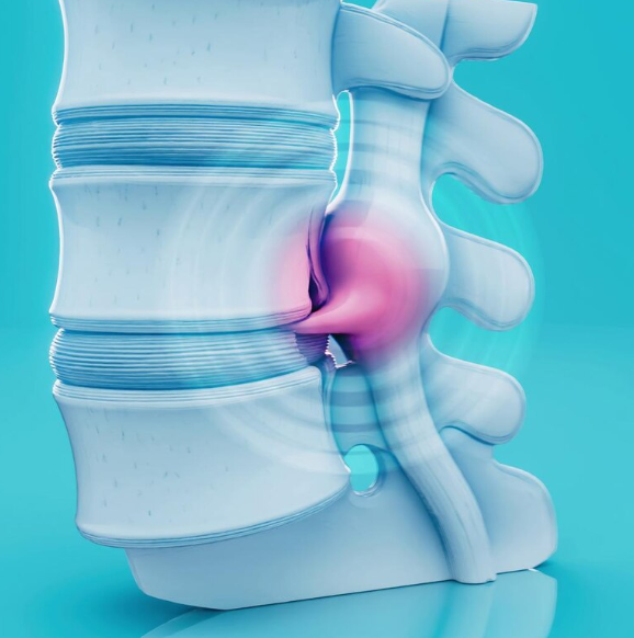 3D illustration of a human vertebral spine with a herniated disc pressing on a nerve.