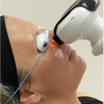 Understanding Lumecca-I: The Latest Treatment for Dry Eye Syndrome