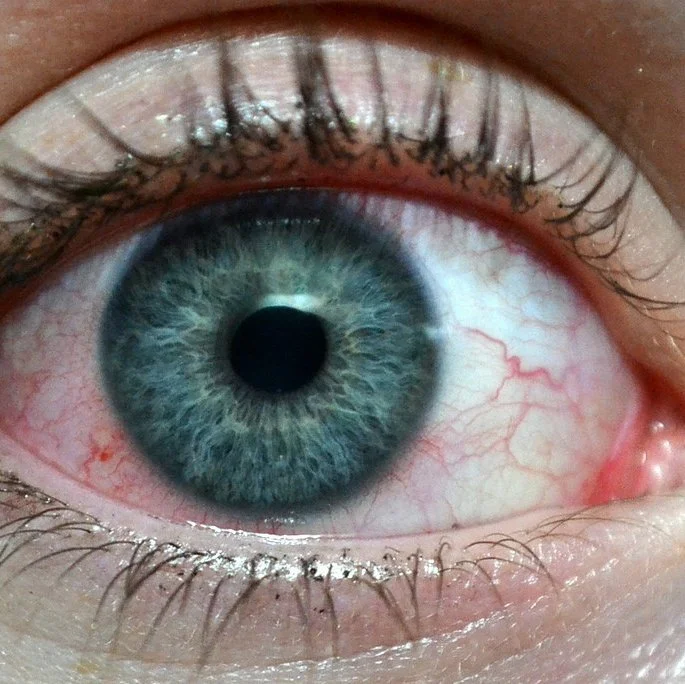 5 Reasons for Watery Eyes, And What to Do About Them