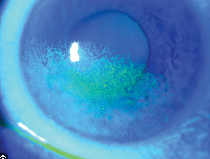 Neurotrophic Keratitis: Understanding Corneal Nerve Damage and Vision Changes