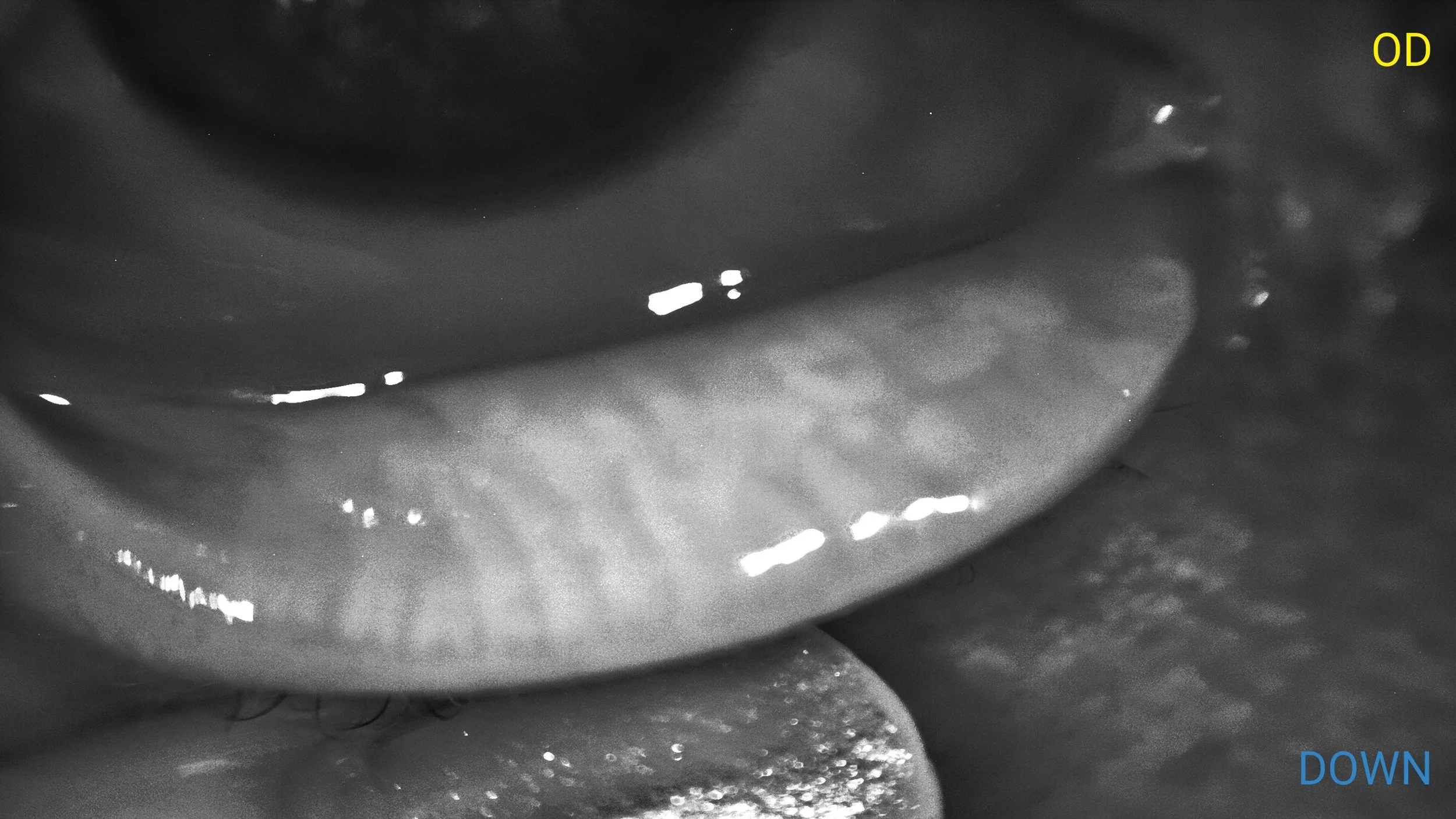 Meibography in Santa Monica: What It Shows and Why It Matters for Dry Eye