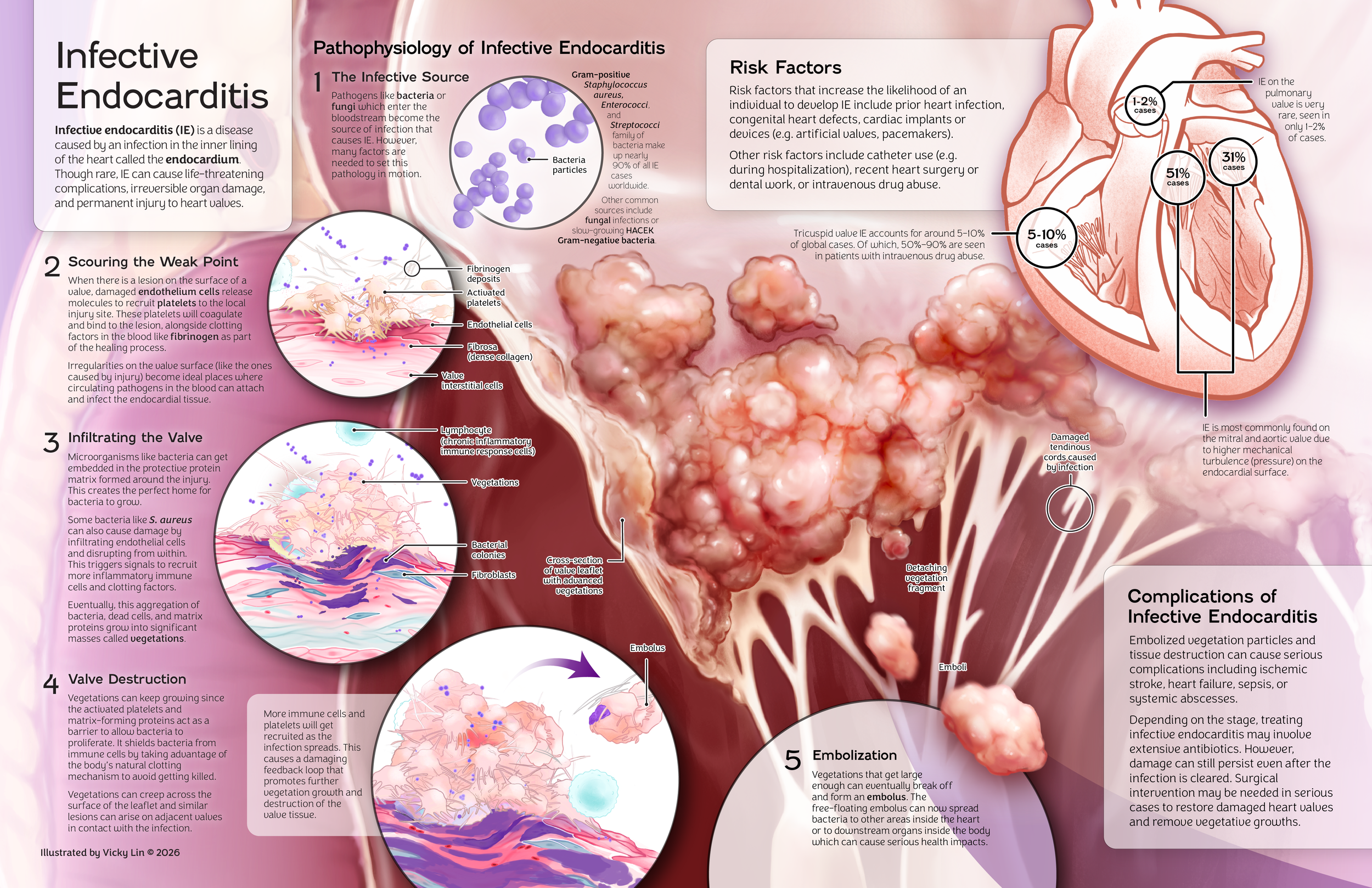 The Pathophysiology of Infective Endocarditis