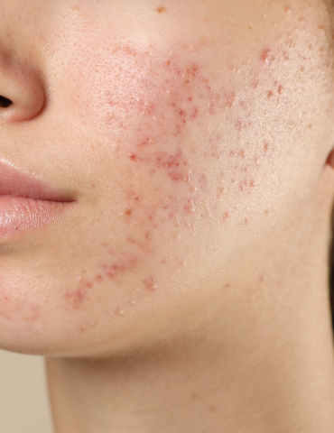 White female with skin acne on cheek