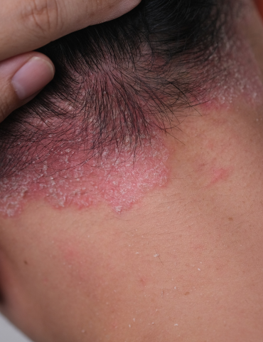 Male with psoriasis on scalp. Flaky white and inflammed red skin