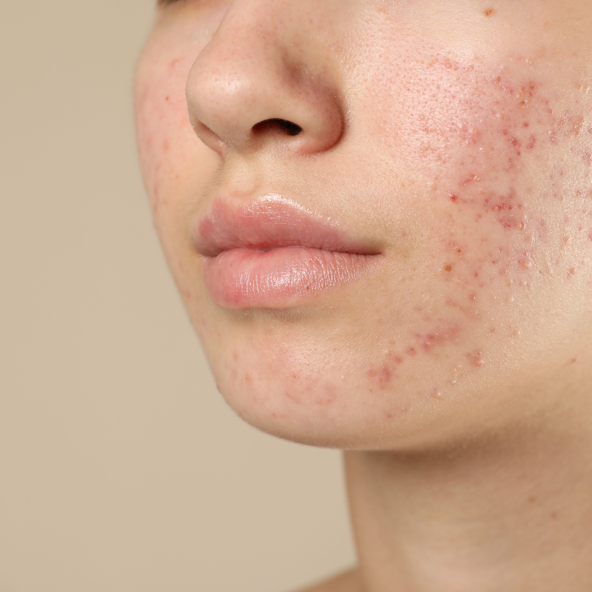 Image of white woman with skin acne