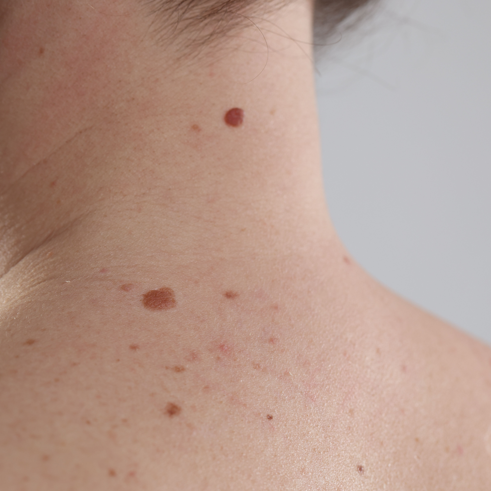 Image of skin moles - Consultant Dermatology Support Leeds