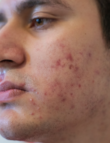 Male with skin acne on the face