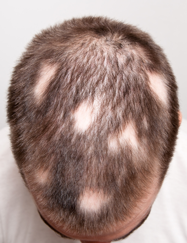 Male with alopecia areata