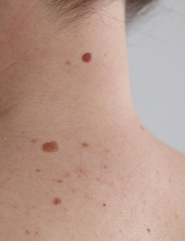 Close-up of a person's neck and shoulder with multiple moles and skin spots.
