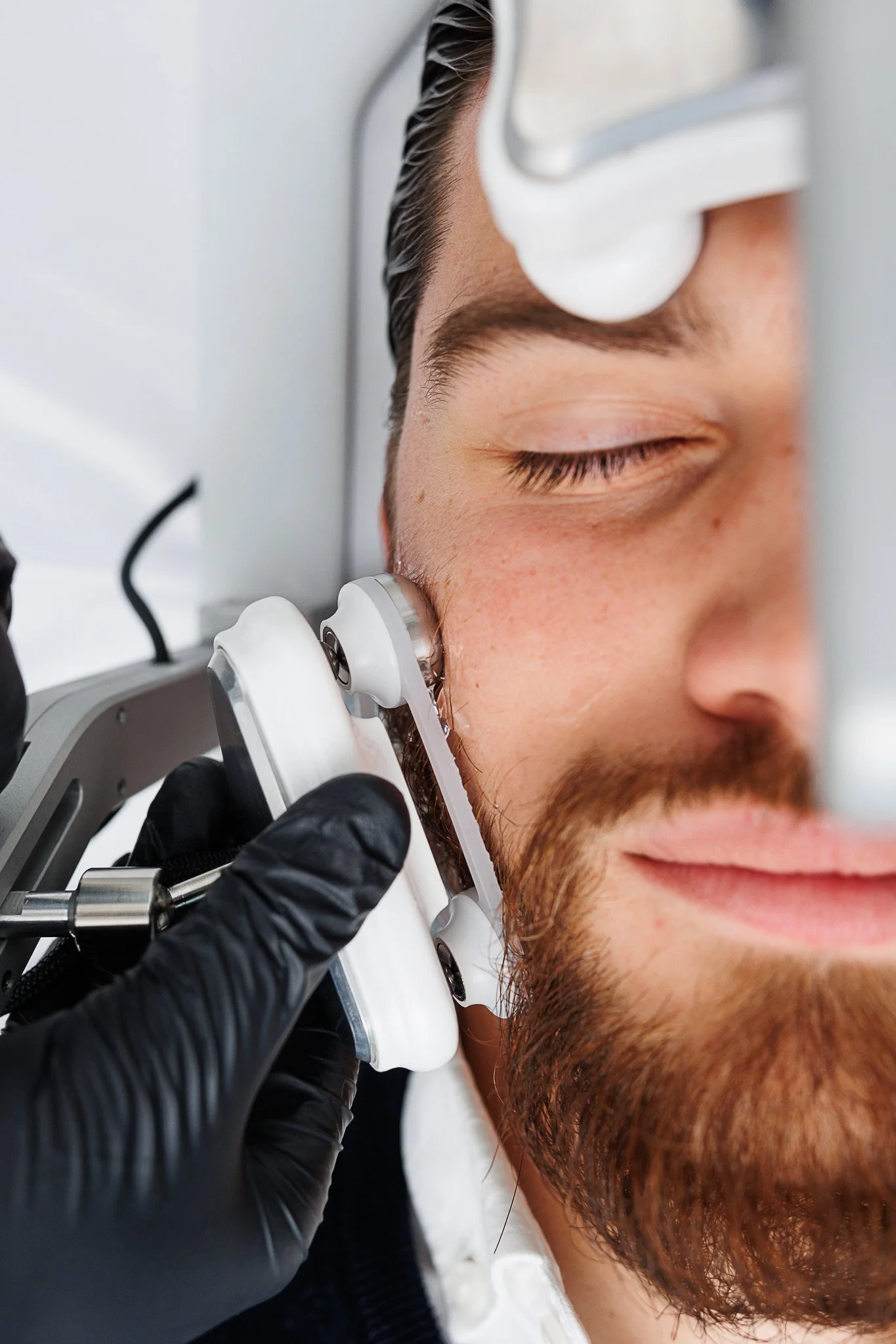 Close-up of a man with a beard getting a facial skin treatment using a laser device on his cheek, with a medical professional wearing black gloves operating the device.