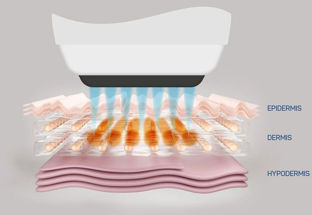Illustration eines Geräts, das Wasserstrahlen auf die Haut sendet, um eine Hautbehandlung durch die Schichten Epidermis, Dermis und Hypodermis zu zeigen.