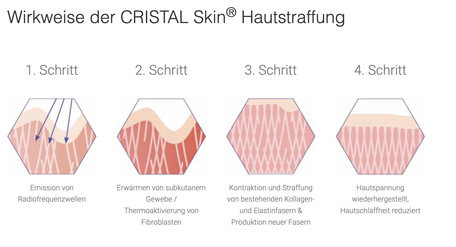 Eine mehrstufige Grafik zeigt die Wirkweise der CRISTAL Skin Hautstraffung, beginnend mit der Emission von Radiofrequenzwellen, die Erwärmung des subkutanen Gewebes und die Thermoaktivierung von Fibroblasten, gefolgt von Kontraktion und Straffung der Kollagen- und Elastinfasern, was die Hautspannung wiederherstellt und die Hautglätte reduziert.