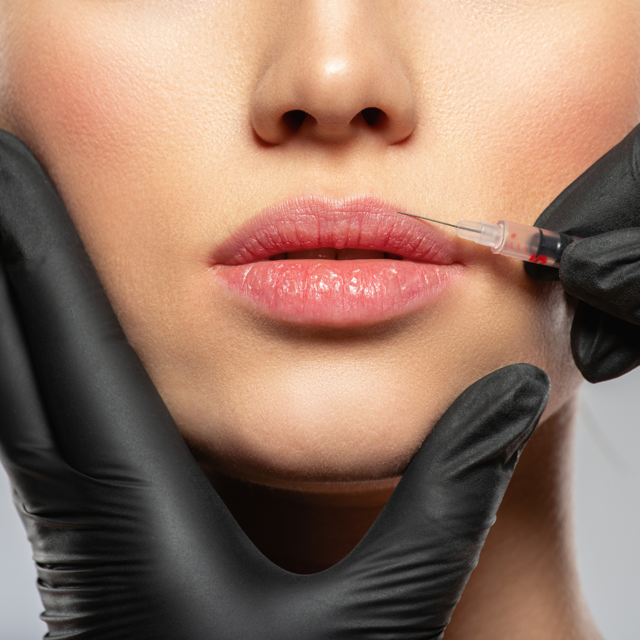 Close-up of a woman’s lips while receiving a lip injection from a healthcare professional wearing black gloves.
