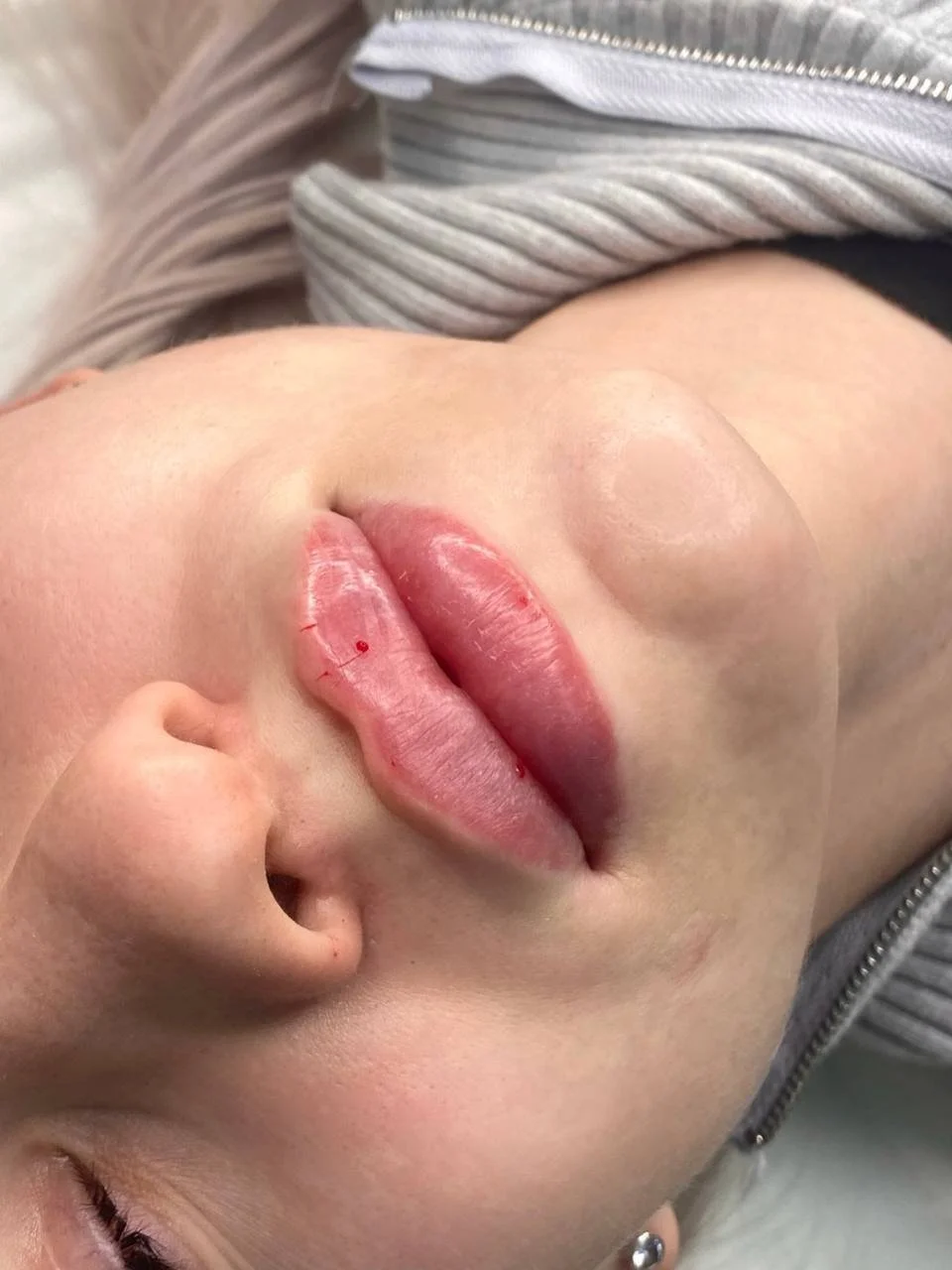 Close-up of a person's face showing their nose, lips, and part of their ear, with a beige and gray striped hoodie in the background.