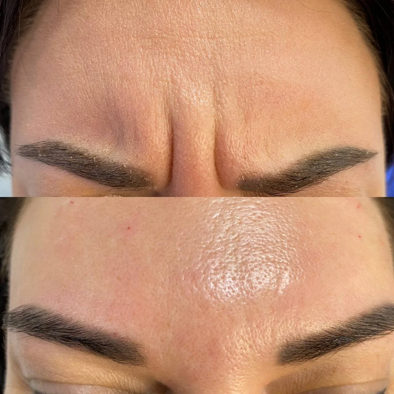 Close-up of a person's forehead before and after skincare treatment showing reduced redness and shininess.