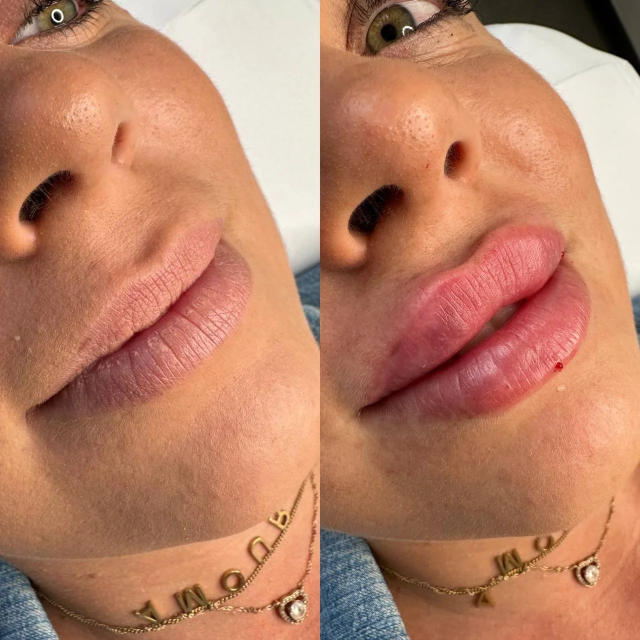 Close-up of a woman's face showing her lips and nose, with the left side featuring natural lips and the right side showing lips with recent lip filler injection. The woman has light skin, brown eyes, and is wearing jewelry including a necklace.