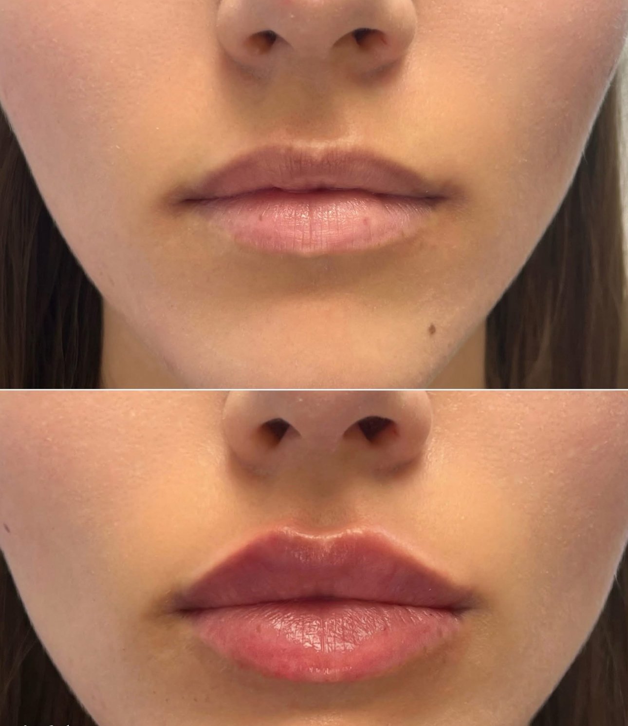 Lip Filler vs Lip Pen: Understanding the Difference