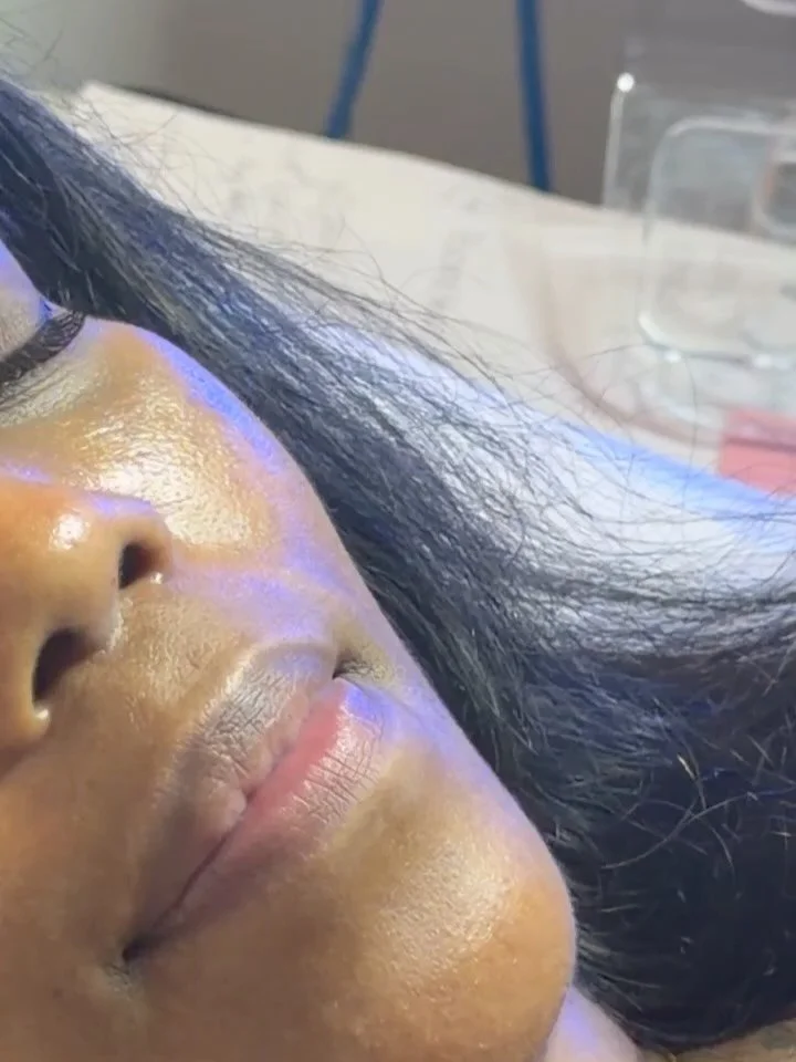 She waited two years for this session&mdash;and the moment finally arrived. 💋

Lip asymmetry is more common than you think, and treating it isn&rsquo;t simply about adding volume. This transformation focused on strategically balancing the upper lip,