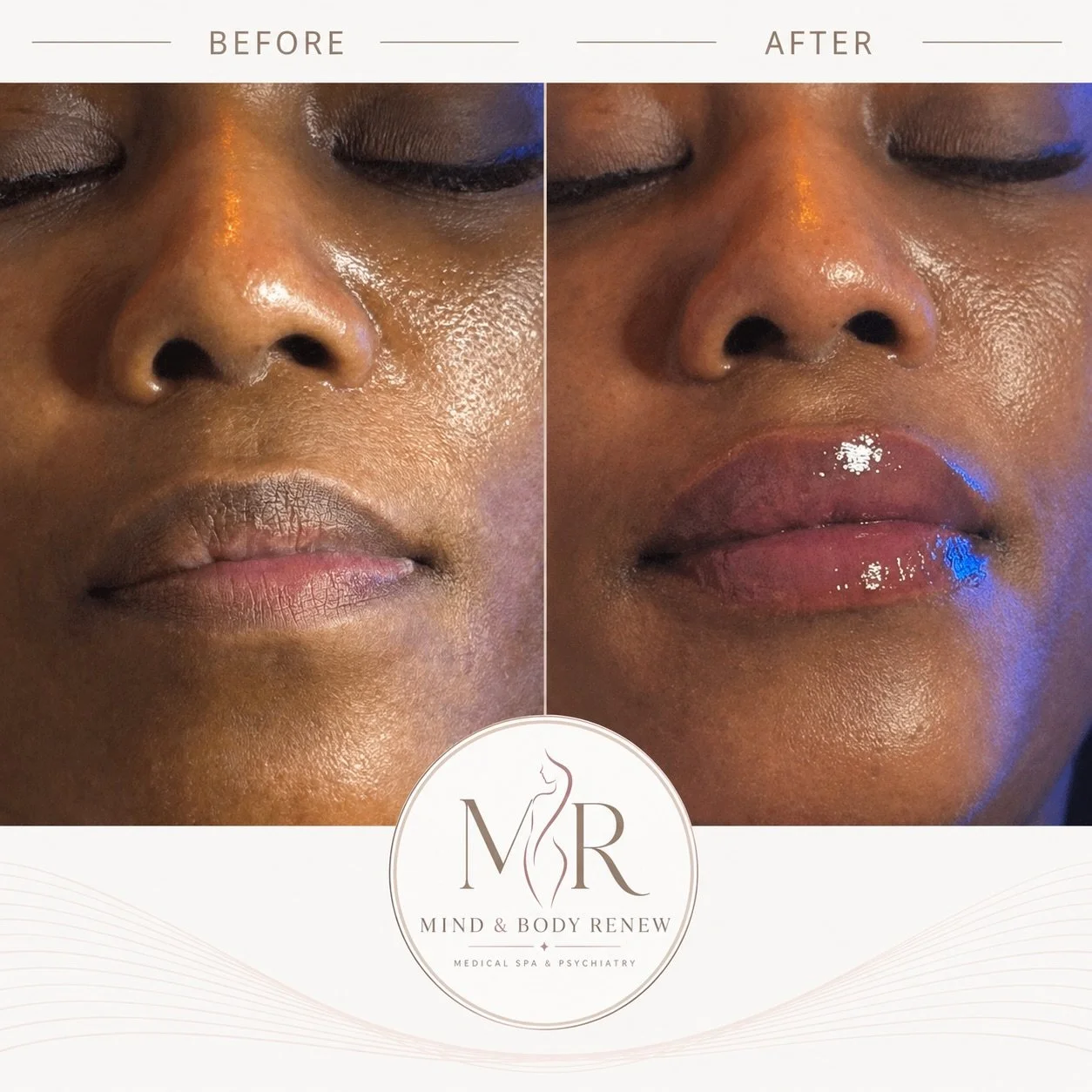 A little enhancement, a beautiful difference. ✨

This before-and-after showcases fuller-looking, hydrated lips with enhanced shape and definition&mdash;all while complementing her natural features.

Every treatment is personalized because no two lips