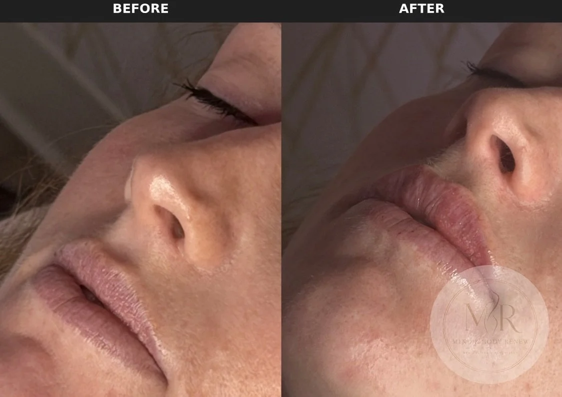 Beautiful balance with just 1 mL ✨

This patient used 1 mL of lip filler to enhance volume, improve definition, and create a soft, hydrated appearance while maintaining natural-looking proportions.

Individual results vary. Consultation required.

#L