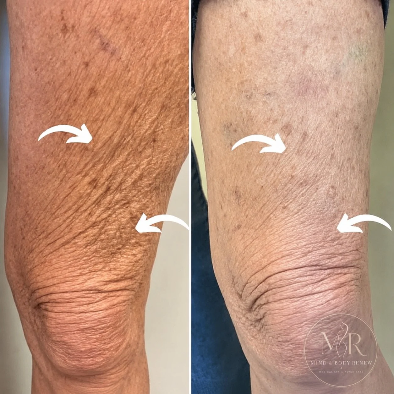 Leg rejuvenation, but make it smooth ✨ This transformation shows visibly firmer, smoother, more refreshed-looking skin around the knees. Because every part of you deserves to feel renewed.

Individual results may vary. Book your consultation to learn